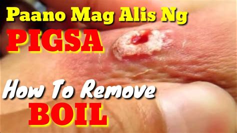busali meaning|How to Treat and Prevent Boils or 'Pigsa' .